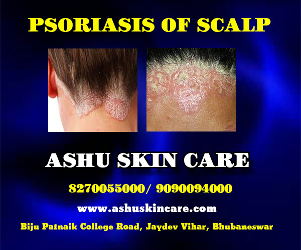 best psoriasis of scalp treatment clinic in bhubaneswar, odisha